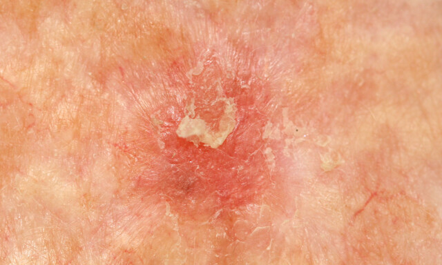 KLASSISK SOLAR KERATOSE: Eksempel på en typisk solar keratasoe med gulhvit skjellende hudoverflate på underliggende rød hud. Slike flekker pleier "å komme og gå". FOTO: NTB Scanpix / Shutterstock / Dermatology11 KLASSISK SOLAR KERATOSE: Eksempel på en typisk solar keratasoe med gulhvit skjellende hudoverflate på underliggende rød hud. Slike flekker pleier "å komme og gå". FOTO: NTB Scanpix / Shutterstock / Dermatology11